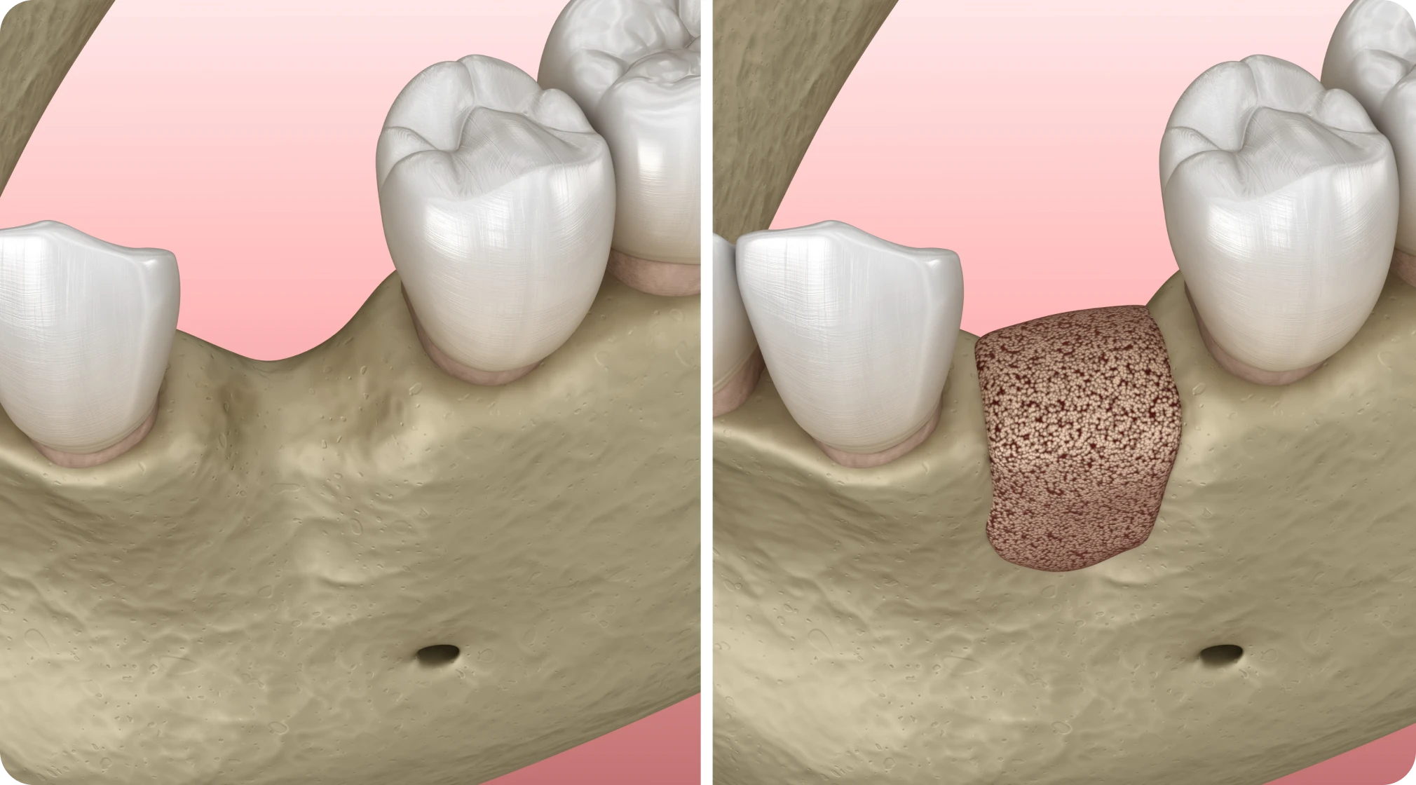 Greffe de gencive | Dentistes Drs Dahlet | Strasbourg