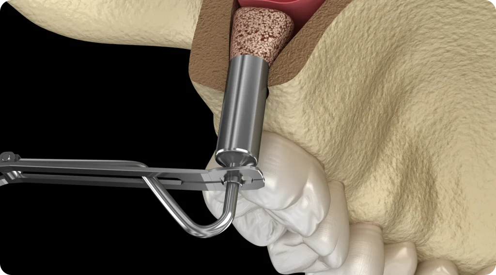 Sinus lift